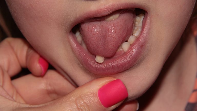 PediatricDentalEmergencyHowtoHandleYourChild'sKnocked-OutTooth